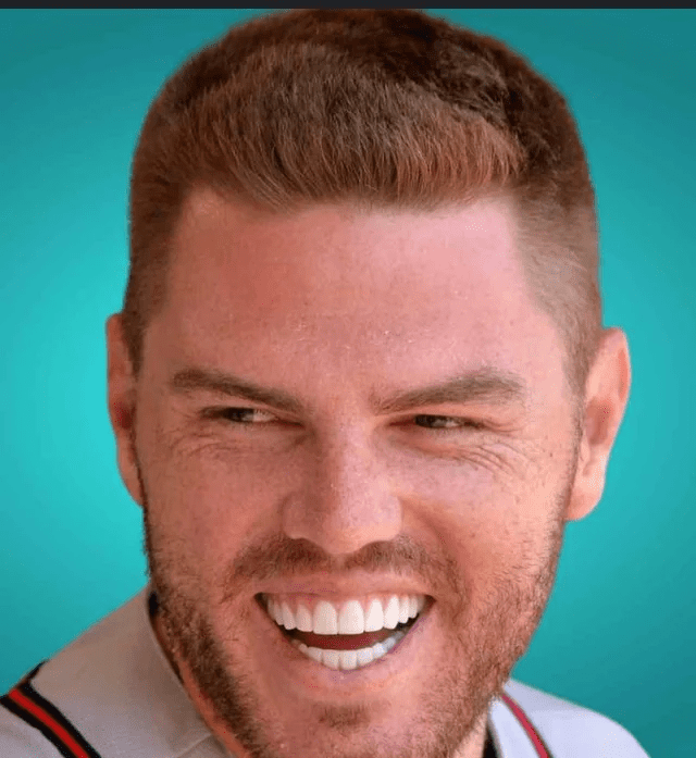 Freddie Freeman Veneers Before and After: Did Cosmetic Dentistry Go Too Far? 3 Close-up of Freddie Freeman smiling with porcelain veneers, showing oversized and ultra-white teeth