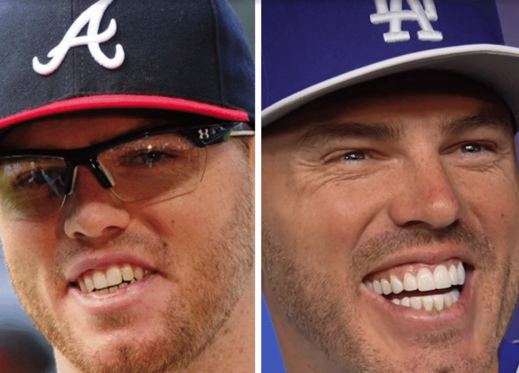 Freddie Freeman Veneers Before and After: Did Cosmetic Dentistry Go Too Far? 2 Side-by-side image of Freddie Freeman in 2025; the right side shows him with noticeably larger, bright white fake teeth, while the left side shows his earlier, natural smile with normal proportions.