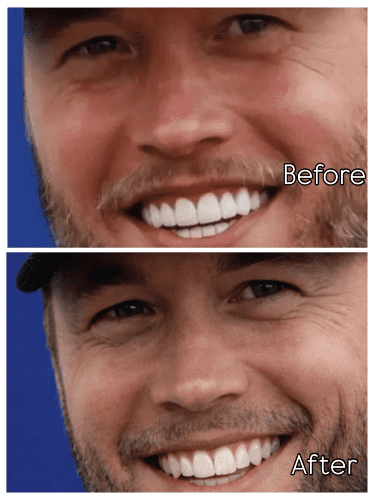 Matthew Stafford Veneers Before and After: Who’s Really to Blame? 9 Natural Smile Mock-Up Method by BBV matthew stafford