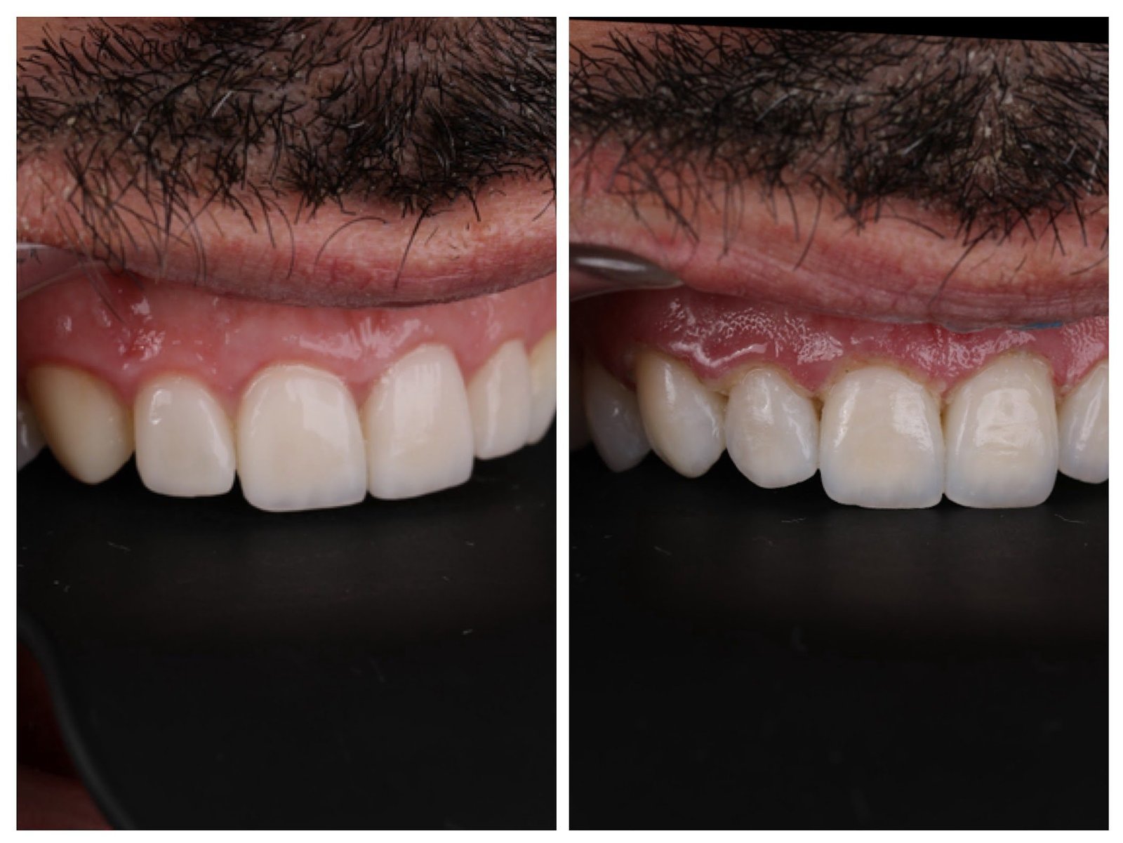 Porcelain Veneer Costs: The Real Price, Lifetime Expenses, and Safer Alternatives 6 Comparison of porcelain veneers on the left versus enhanced composite resin veneers on the right. Composite veneers look natural, preserve enamel, and are repairable without full replacement.