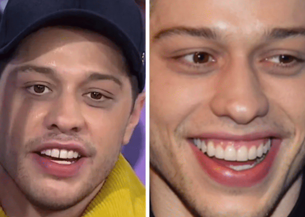 Right: porcelain veneers. Left: adjusted veneers to recreate his original front gap after not being happy with the first result.