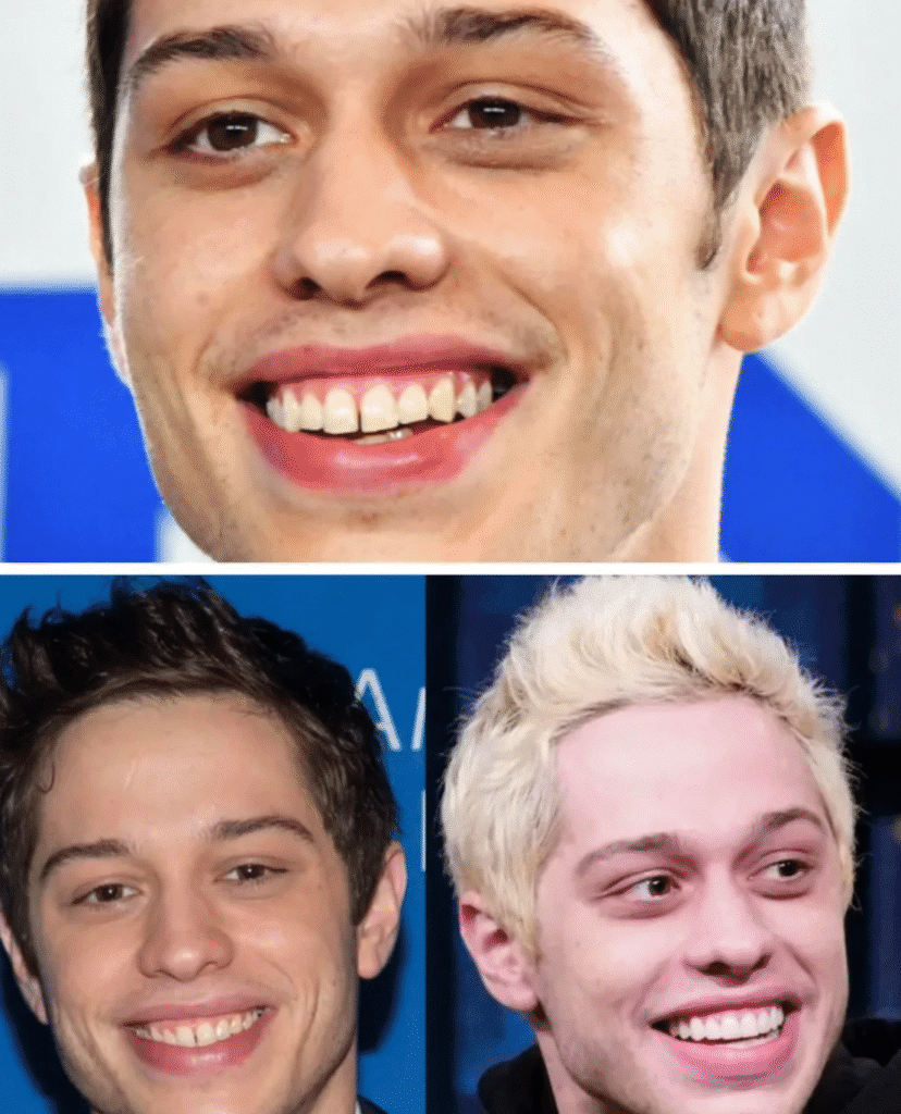 Pete Davidson’s natural teeth shown in the top and bottom left photos, compared to the bottom right where porcelain veneers give him a brighter but more artificial smile.