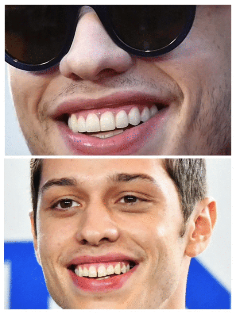 Comparison of Pete Davidson’s teeth before and after veneers. The lower image shows his natural smile with a small gap and uneven edges, while the upper image shows his new, uniform veneer smile that looks more artificial.