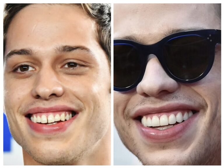 pete davison veneers