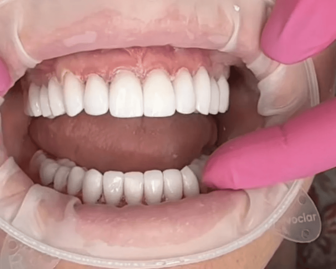 Porcelain Veneers on Healthy Teeth: The Upgrade That Becomes a Disaster You Never See Online
